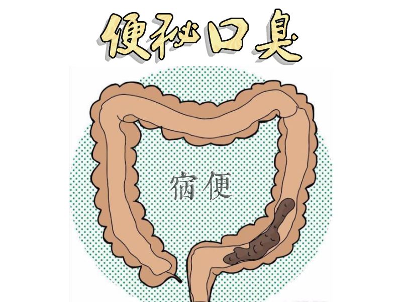 宿便堆积图