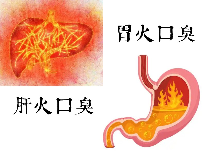 两种上火口臭